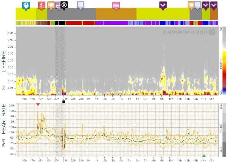 39 årig kvindelig triatlet med influenza heart rate variability